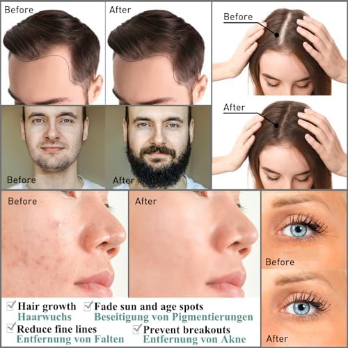 Derma Roller